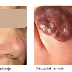 Zmiany naczyniowe na skórze: przyczyny, objawy i skuteczne leczenie