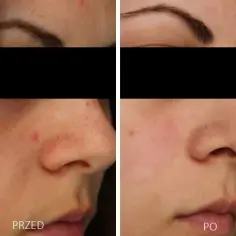 Najskuteczniejsze zabiegi na oczyszczanie twarzy - poznaj 4 sprawdzone metody