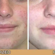 Retinol w kosmetologii: Jak stosować i jakie efekty osiągnąć