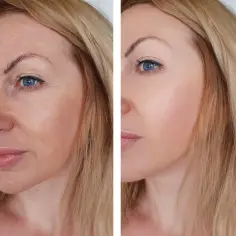 Peeling z retinolem: opinie, efekty i skutki uboczne zabiegu