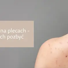 Blizny potrądzikowe na plecach - jak się ich skutecznie pozbyć?