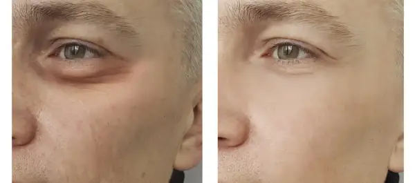 Skuteczne zabiegi rozjaśniające cienie pod oczami - efekty i metody